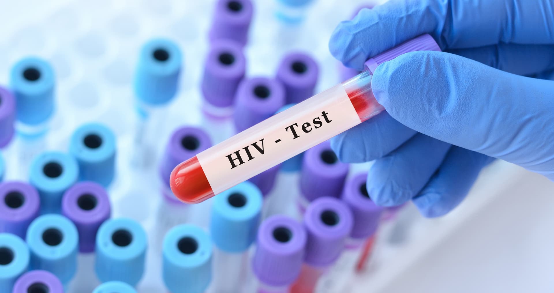 فحص  نقص المناعة  (HIV)